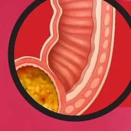 Ilustração de coleção cavitária