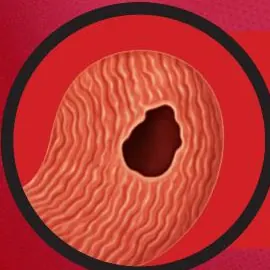 Ilustração de perfuração da parede digestiva
